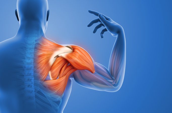 Inflamed shoulder muscle and painful joint. Highlights anatomy, muscle strain, and inflammation around the shoulder region. Ideal for healthcare, physiotherapy, and educational use. Useful for explaining shoulder pain, tendonitis, arthritis, or injury in clinical presentations, anatomy visuals, and patient education materials.