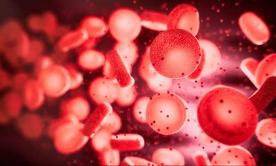 PRP Hair Restoration 1
