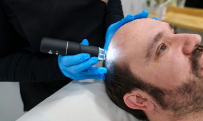 PRP Hair Restoration 2