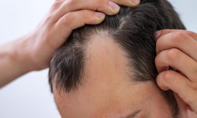 PRP Hair Restoration