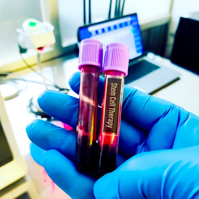 Blood sample for cell therapy testing. Several studies have shown that using stem cell therapy can be a treatment option for type 2 diabetes mellites.